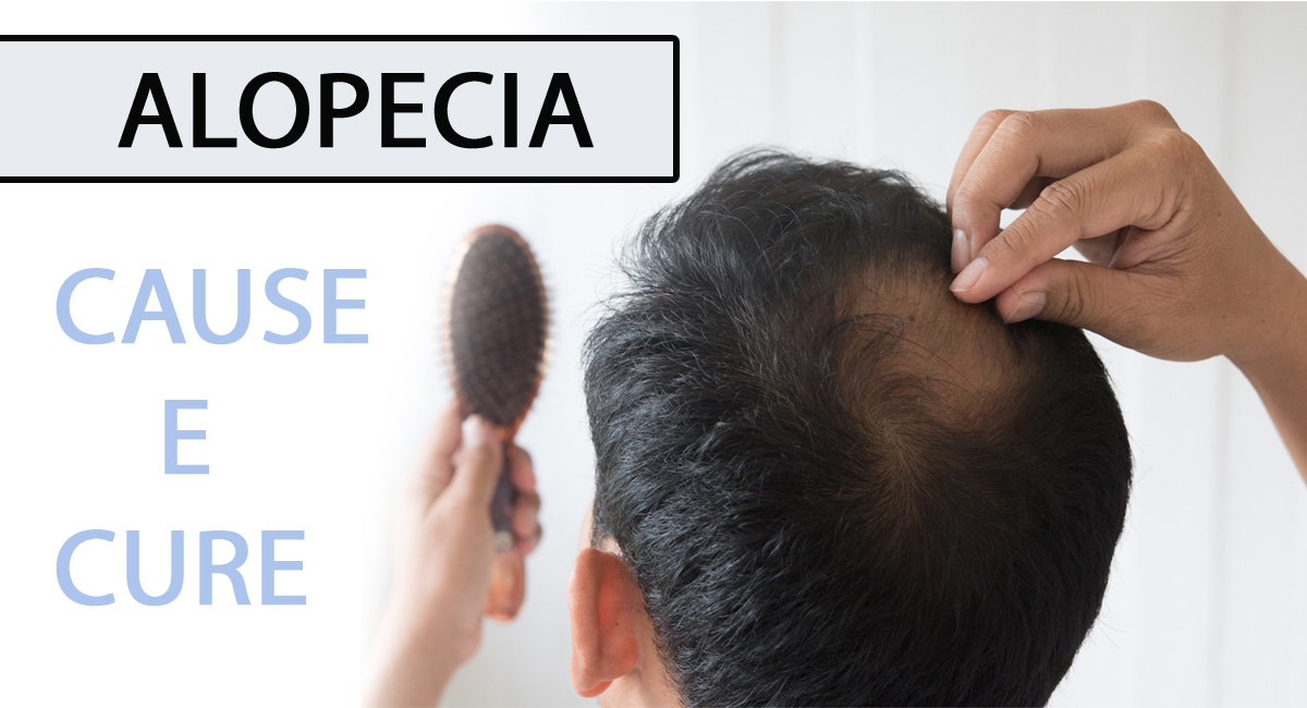 Alopecia Androgenetica Cause Cure E Trattamenti